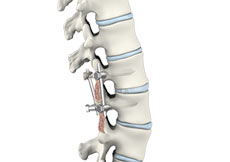 Posterior Lumbar Interbody Fusion