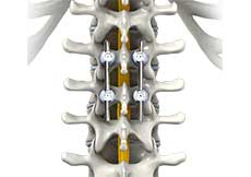 Posterior Thoracic Fusion