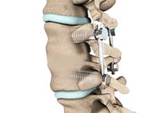 Posterolateral Lumbar Fusion