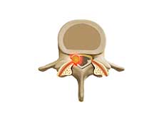 Removal of Facet Joint Cyst