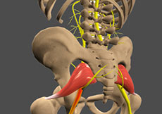 Sciatica