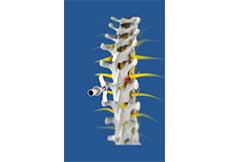 Spinal Facet Rhizotomy