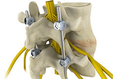 Spinal Fusion