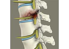 Spinal Infection Debridement