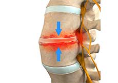 Spinal Infection Decompression