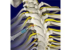 Spinal Nerve Blocks