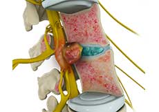 Spinal Tumor Surgery