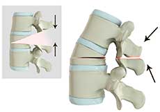 Spine Osteotomy