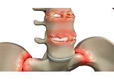 spondyloarthropathies