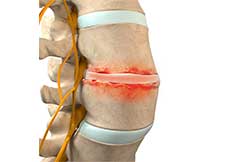 Spondylodiscitis