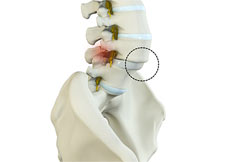 Spondylolisthesis