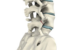 Spondylolysis