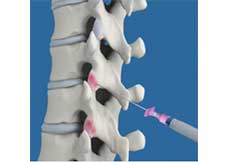 Thoracic Facet Joint Injection