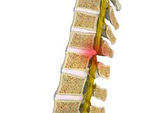 Thoracic Myelopathy