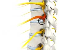 Thoracic Nerve Compression