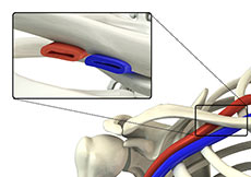 Thoracic Outlet Syndrome