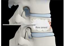 Thoracic Vertebroplasty