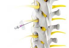 Transforaminal Epidural Block