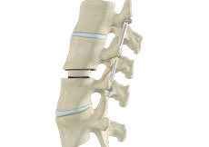 Transforaminal Lumbar Interbody Fusion