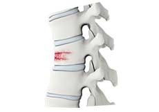 Vertebral Compression Fractures