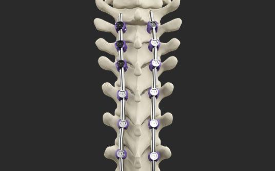 Scoliosis Surgery